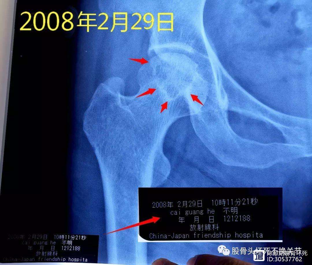 白城人工骨头医保报销多少(人工骨头医保报销多少比例)